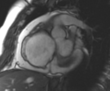 Arrhythmogenic right ventricular cardiomyopathy (Radiopaedia 69431-79307 Short axis cine 219).jpg