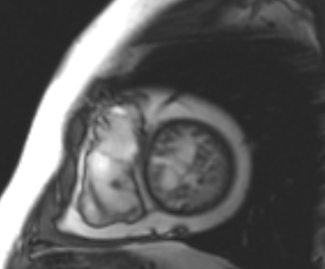 File:Arrhythmogenic right ventricular cardiomyopathy (Radiopaedia 69431-79307 Short axis cine 43).jpg