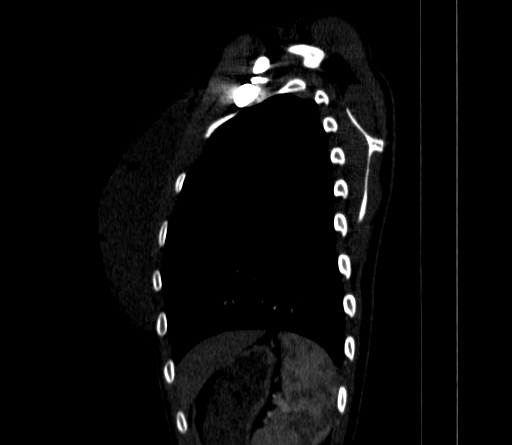 Arteria lusoria (Radiopaedia 88528-105192 C 75).jpg