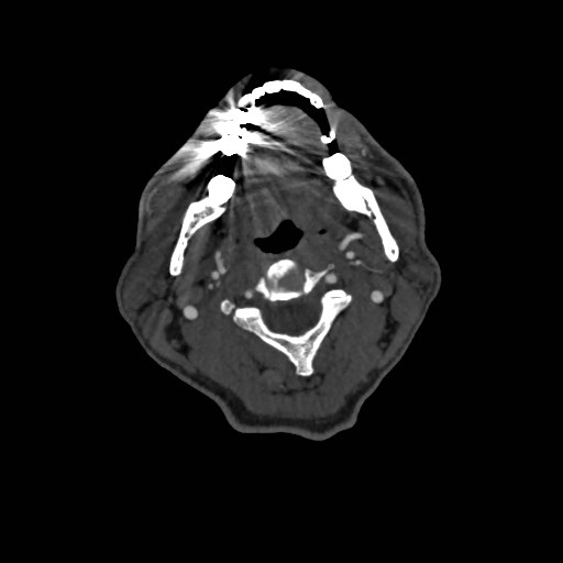 File:Artery of Percheron infarct (Radiopaedia 48088-52894 A 84).jpg