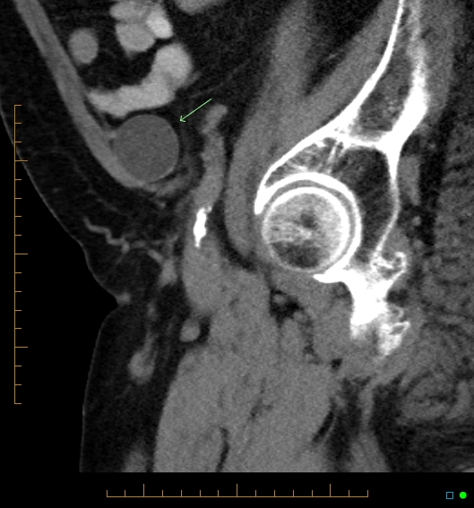File:Artificial urethral sphincter (Radiopaedia 46937-51464 Sagittal C+ delayed 5).jpg