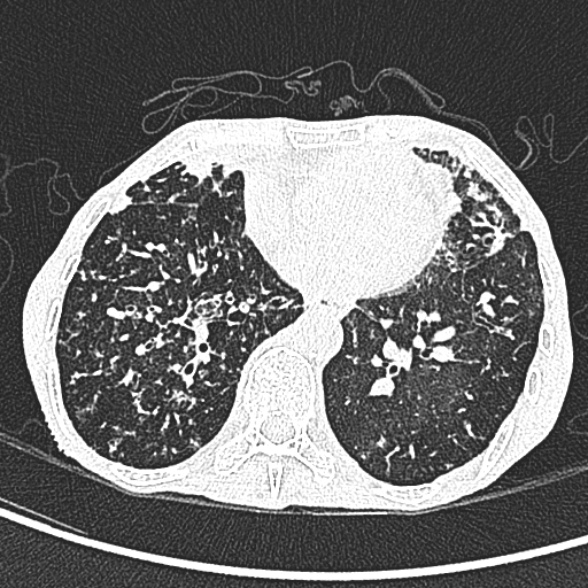 Aspergilloma- with Monod sign (Radiopaedia 44737-48532 Axial lung window 183).jpg