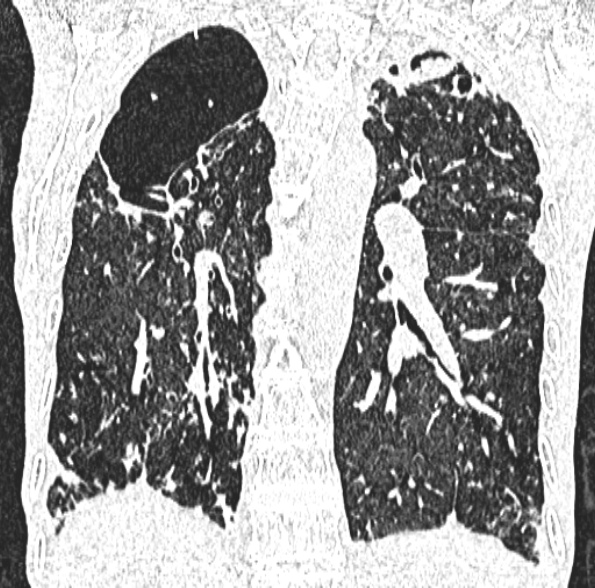 Aspergilloma- with Monod sign (Radiopaedia 44737-48532 Coronal lung window 307).jpg