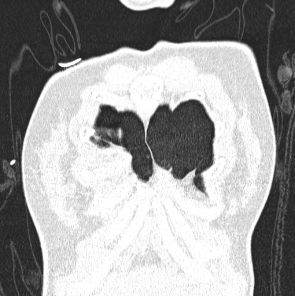 File:Aspergilloma (Radiopaedia 26223-26347 Coronal lung window 6).jpg