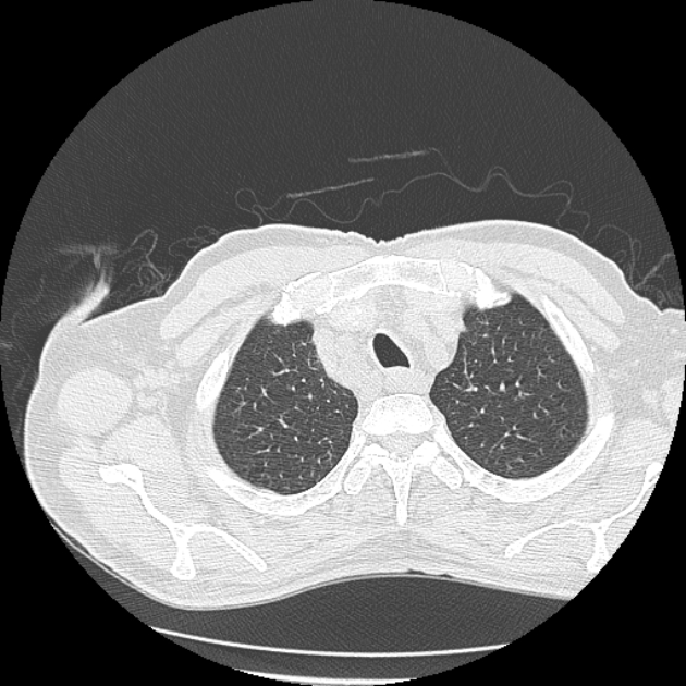 Aspergilloma (Radiopaedia 44592-48327 Axial lung window 8).jpg