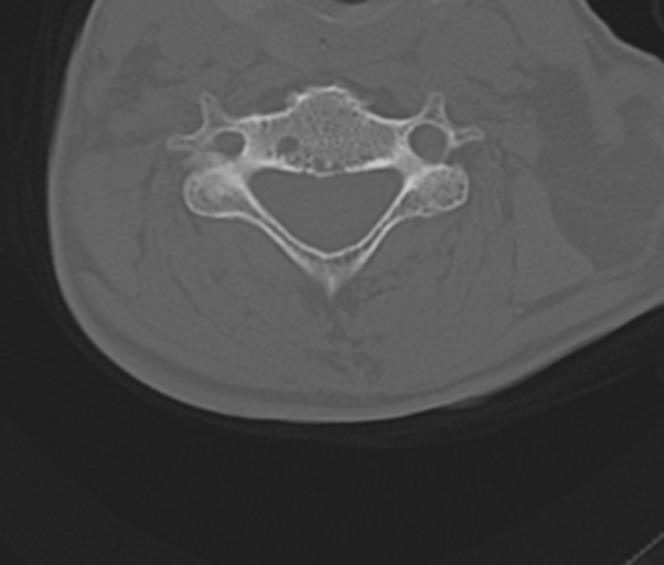 Atlanto-axial subluxation (Radiopaedia 36610-38176 Axial bone window 35).png