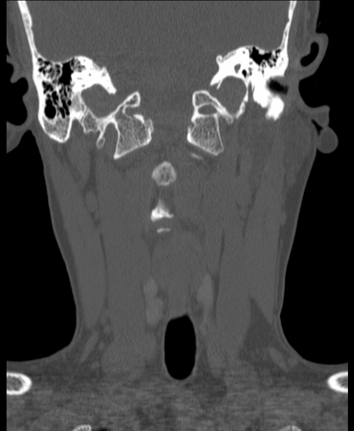 Atlanto-occipital assimilation with basilar invagination (Radiopaedia 70122-80188 Coronal bone window 63).jpg