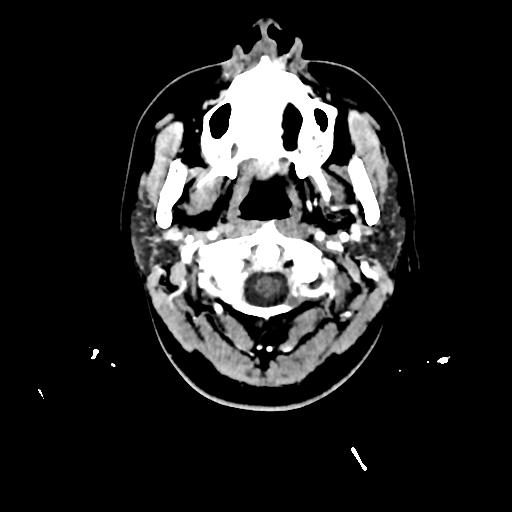 Atretic cephalocele (Radiopaedia 89782-106881 Axial with contrast 6).jpg