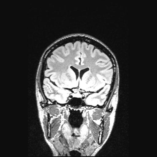Atretic encephalocoele with inferior vermis hypoplasia (Radiopaedia 30443-31108 Coronal FLAIR 117).jpg