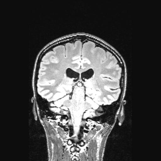 Atretic encephalocoele with inferior vermis hypoplasia (Radiopaedia 30443-31108 Coronal FLAIR 76).jpg