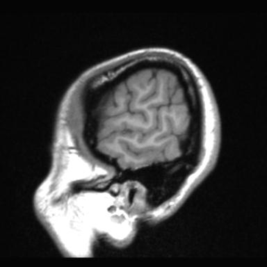 Atretic encephalocoele with inferior vermis hypoplasia (Radiopaedia 30443-31108 Sagittal T1 122).jpg