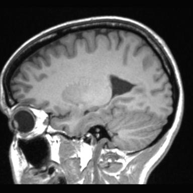 Atretic encephalocoele with inferior vermis hypoplasia (Radiopaedia 30443-31108 Sagittal T1 41).jpg