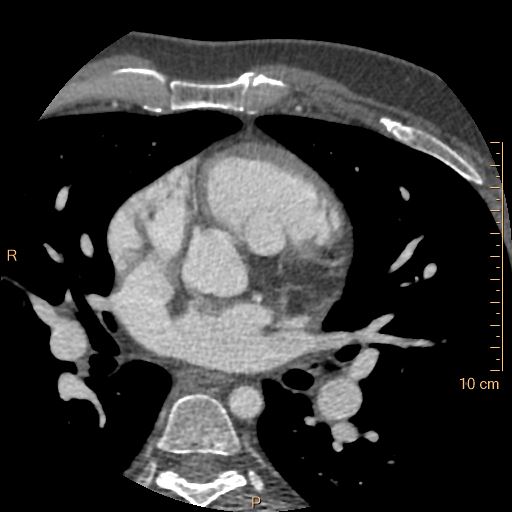 File:Atrial septal defect (upper sinus venosus type) with partial anomalous pulmonary venous return into superior vena cava (Radiopaedia 73228-83961 A 101).jpg
