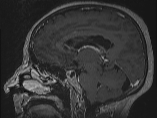 Atypical meningioma (Radiopaedia 62985-71406 Sagittal T1 C+ 40).jpg