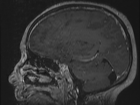 Atypical meningioma (Radiopaedia 62985-71406 Sagittal T1 C+ 54).jpg