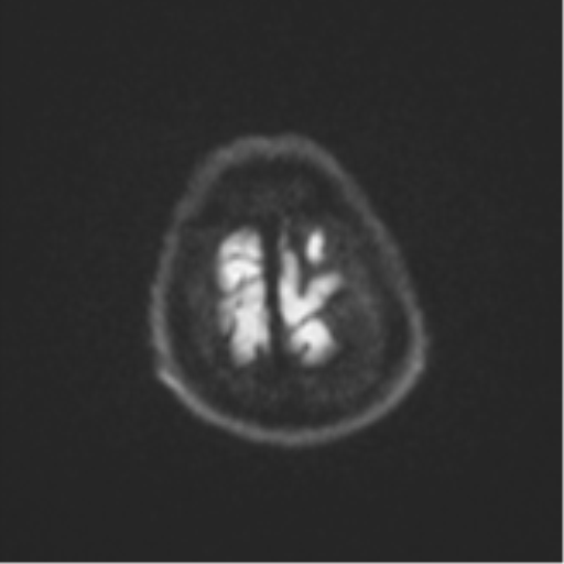 Atypical meningioma (WHO Grade II) (Radiopaedia 54742-60979 Axial DWI 54).png