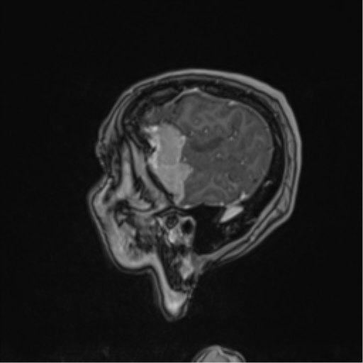 Atypical meningioma (WHO Grade II) (Radiopaedia 54742-60979 Sagittal T1 C+ 64).png