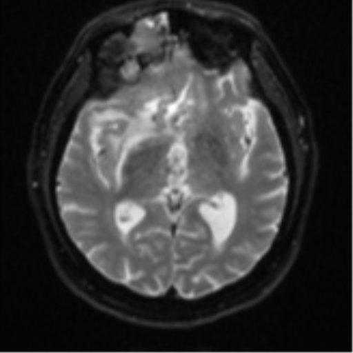 Atypical meningioma (WHO grade II) with brain invasion (Radiopaedia 57767-64729 Axial DWI 14).png