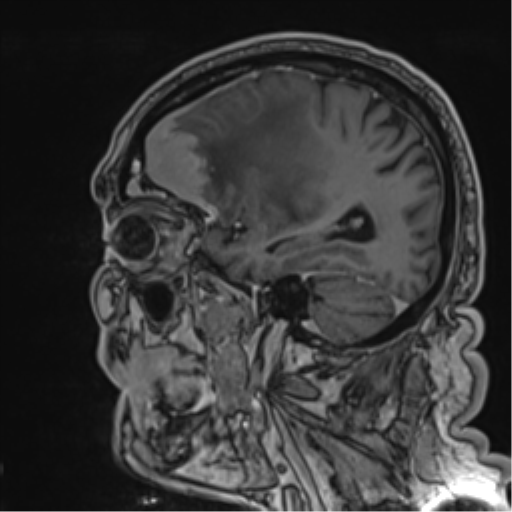 Atypical meningioma (WHO grade II) with brain invasion (Radiopaedia 57767-64729 Sagittal T1 C+ 47).png