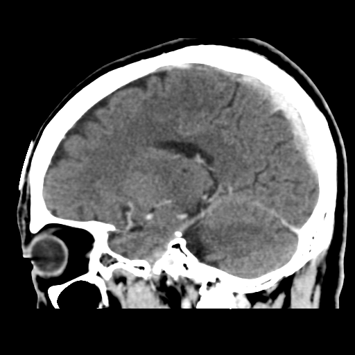 Atypical meningioma (WHO grade II) with osseous invasion (Radiopaedia 53654-59715 G 34).png