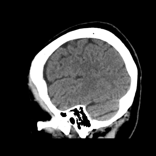 File:Atypical meningioma with skull invasion (Radiopaedia 34357-35649 E 44).png