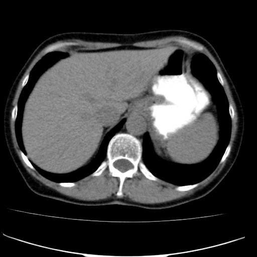 File:Atypical renal cyst (Radiopaedia 17536-17251 non-contrast 1).jpg