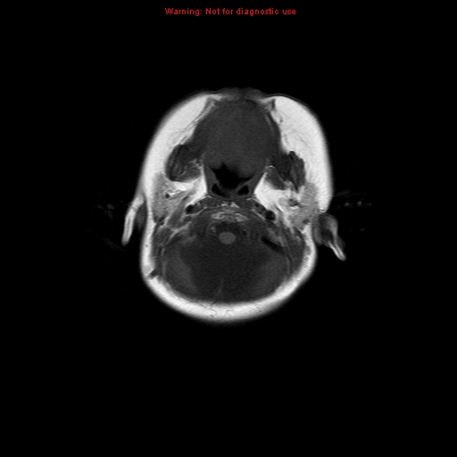 File:Atypical teratoid rhabdoid tumor (Radiopaedia 10712-11183 Axial T1 17).jpg