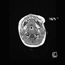 Atypical teratoid rhabdoid tumor (prenatal US and neonatal MRI) (Radiopaedia 59091-66388 Axial T1 C+ 4).jpg