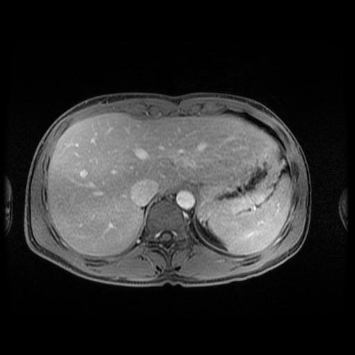 Autoimmune pancreatitis (Radiopaedia 69751-79729 Axial T1 C+ fat sat 29).jpg