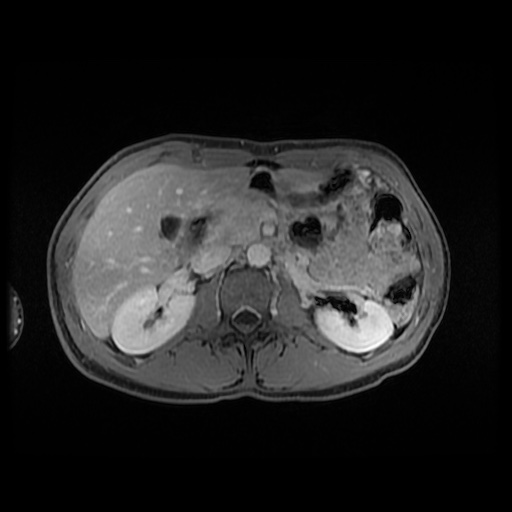 Autoimmune pancreatitis (Radiopaedia 69751-79729 Axial T1 C+ fat sat 68).jpg
