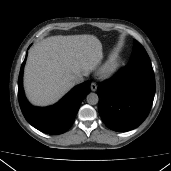 File:Autosomal dominant polycystic kidney disease (Radiopaedia 36539-38101 Axial non-contrast 10).jpg