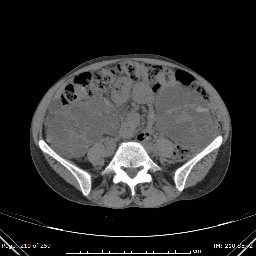 File:Autosomal dominant polycystic kidney disease (Radiopaedia 44122-47684 Axial 56).jpg
