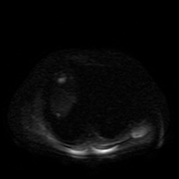 File:Autosomal dominant polycystic kidney disease (Radiopaedia 50259-55611 Axial DWI 38).jpg