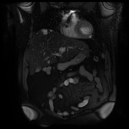 File:Autosomal dominant polycystic kidney disease (Radiopaedia 50259-55611 Coronal FIESTA 10).jpg