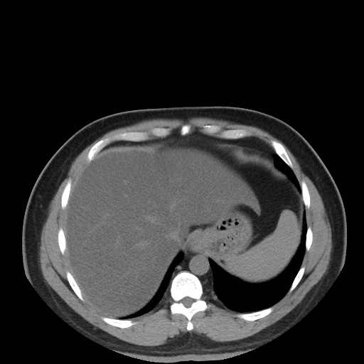 Autosomal dominant polycystic kidney disease (Radiopaedia 50259-55612 Axial non-contrast 17).jpg
