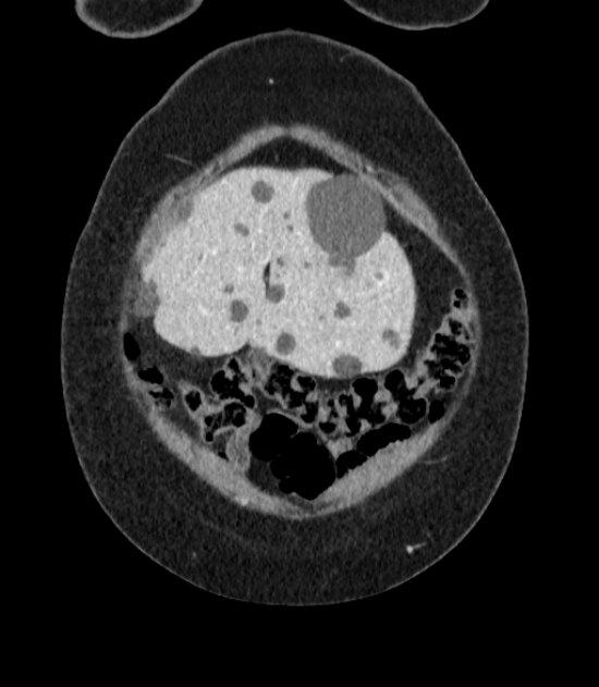 Autosomal dominant polycystic kidney disease (Radiopaedia 57124-64017 B 7).jpg