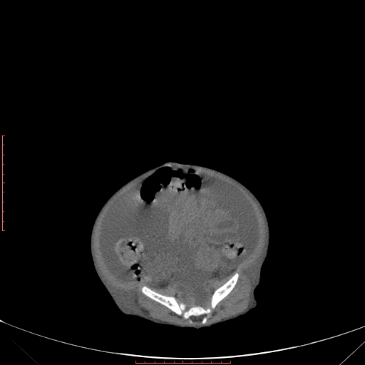 Autosomal recessive polycystic kidney disease associated with Caroli disease (Radiopaedia 61932-69984 Axial non-contrast 296).jpg