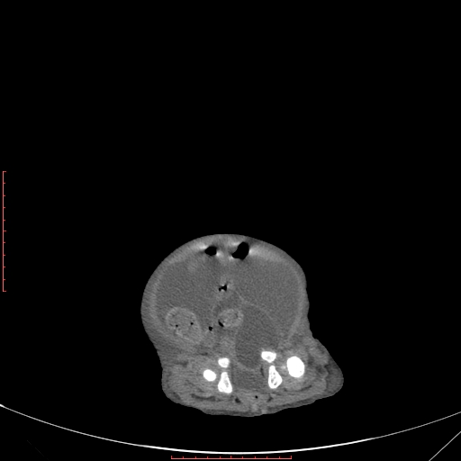 File:Autosomal recessive polycystic kidney disease associated with Caroli disease (Radiopaedia 61932-69984 Axial non-contrast 334).jpg