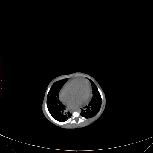 Autosomal recessive polycystic kidney disease associated with Caroli disease (Radiopaedia 61932-69984 B 79).jpg