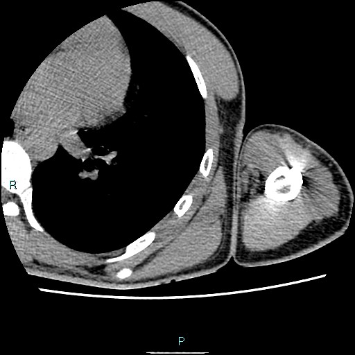 File:Avascular necrosis after fracture dislocations of the proximal humerus (Radiopaedia 88078-104653 D 86).jpg