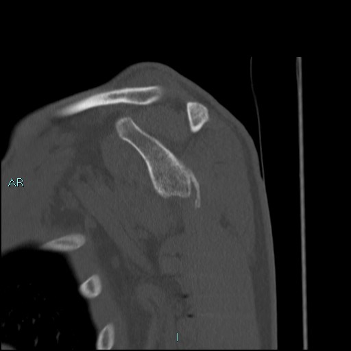 Avascular necrosis after fracture dislocations of the proximal humerus (Radiopaedia 88078-104653 Sagittal bone window 39).jpg