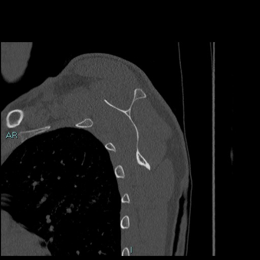 Avascular necrosis after fracture dislocations of the proximal humerus (Radiopaedia 88078-104655 Sagittal bone window 54).jpg