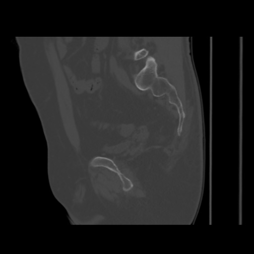 Avascular necrosis of the hip (Radiopaedia 61503-69467 B 36).jpg