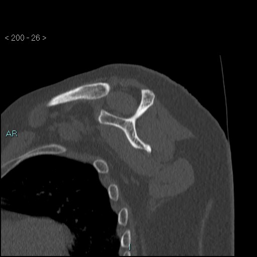 Avascular necrosis of the shoulder - Cruess stage I (Radiopaedia 77674-89887 Sagittal bone window 25).jpg