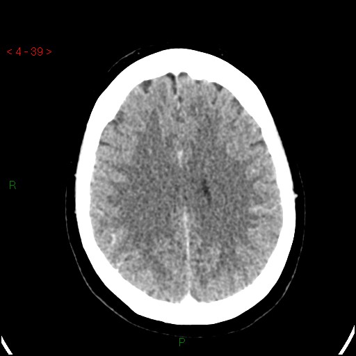 Azygos anterior cerebral artery (Radiopaedia 51987-57833 A 39).jpg