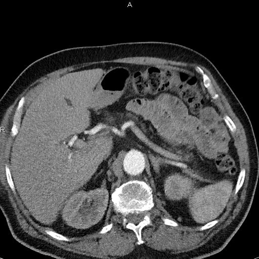 File:Azygos continuation of the inferior vena cava (Radiopaedia 18537-18404 C+ arterial phase 59).jpg