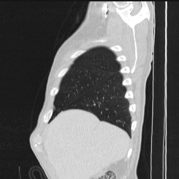Azygos lobe (Radiopaedia 38259-40275 lung window 16).jpg