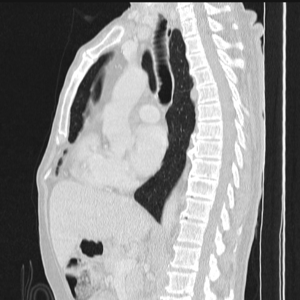 Azygos lobe (Radiopaedia 38259-40275 lung window 50).jpg