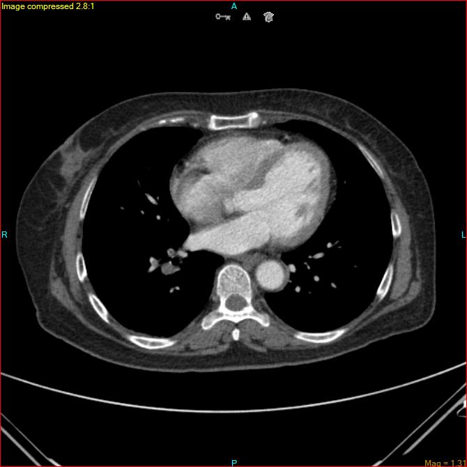 Azygos vein aneurysm (Radiopaedia 77824-90130 B 36).jpg