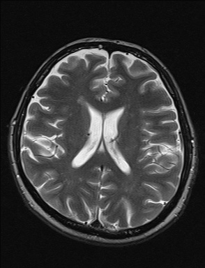 File:Balo concentric sclerosis (Radiopaedia 50458-55940 Axial T2 18).jpg